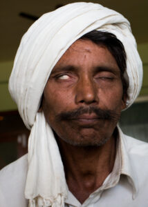 leprosy delhi india (1)
