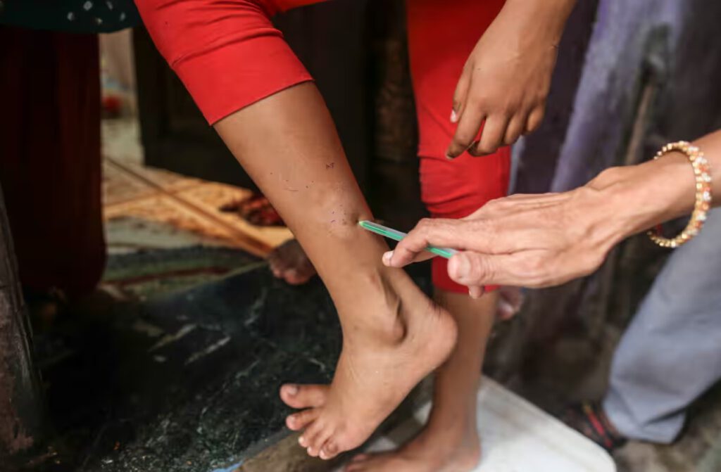 leprosy in delhi india 1