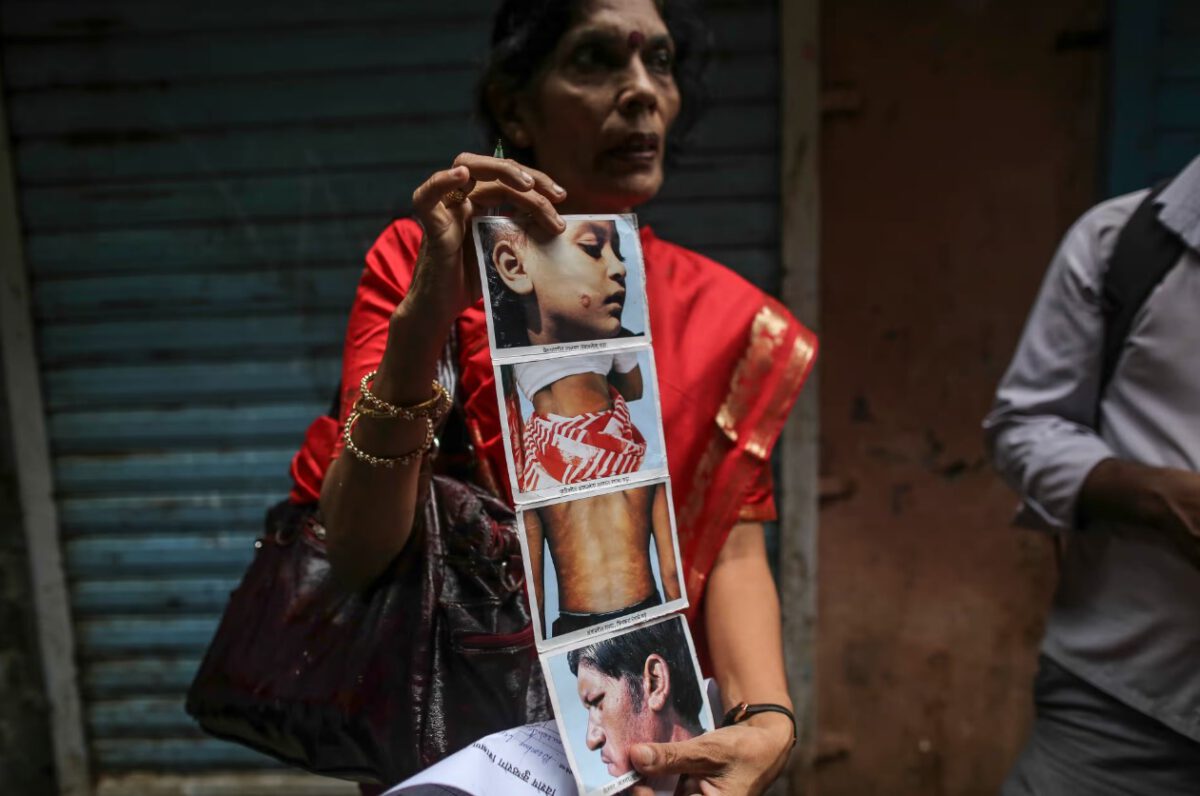 leprosy in delhi india 2